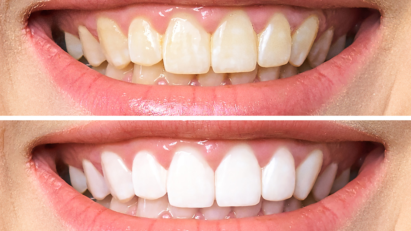 blanchiment-des-dents-Sion-VSDental-dentiste-esthetique-dentaire